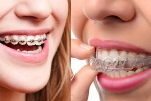 Ce noutati aduce aparatul dentar Invisalign?